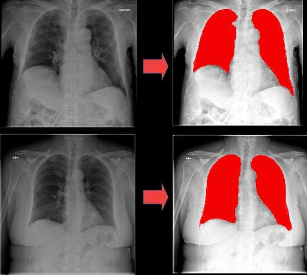 Radiografie polmonari